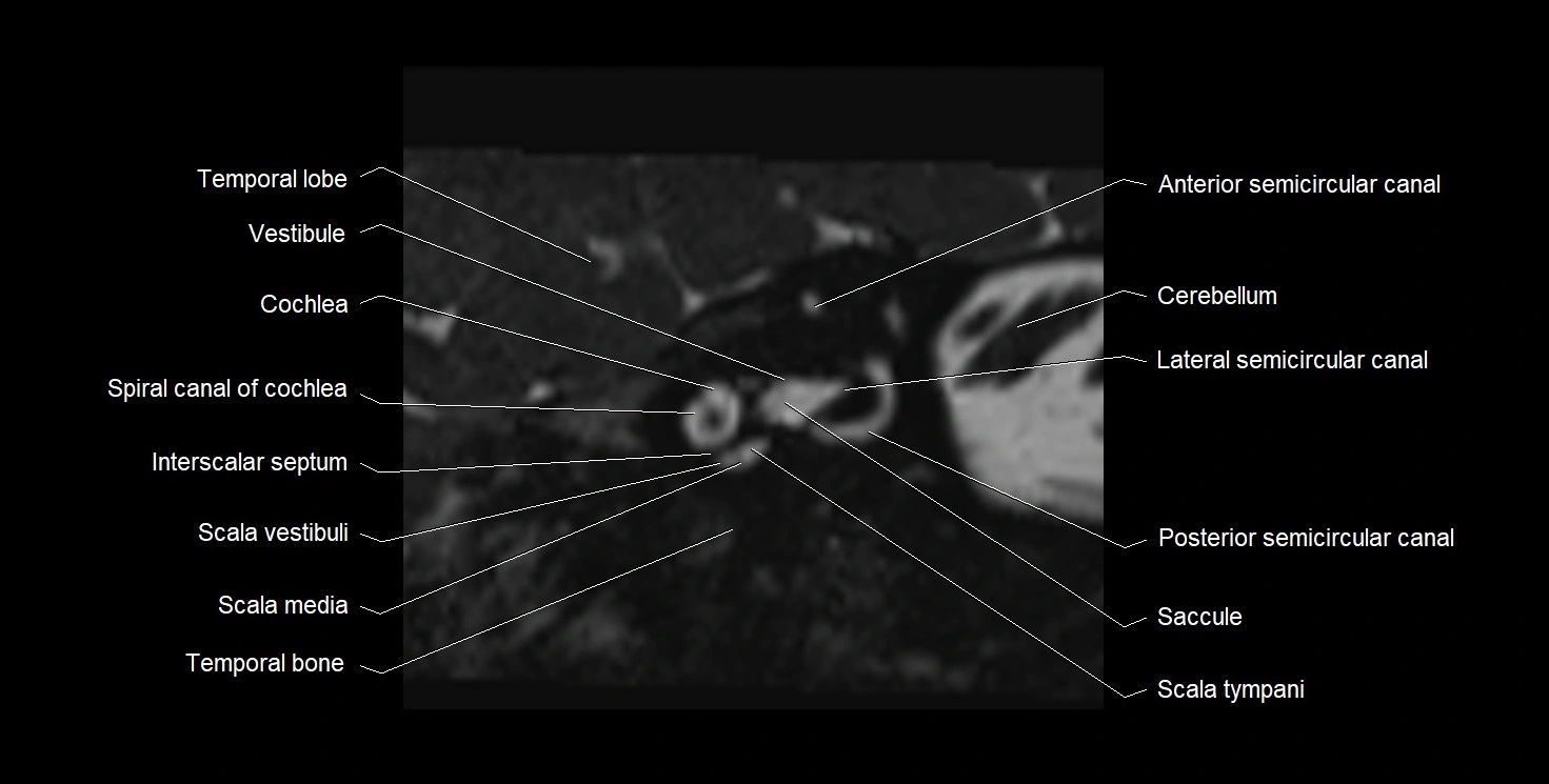 Internal auditory meatus (IAM) 3T sagittal cross sectional anatomy image 9.webp